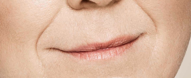 labios de mujer antes de tratamiento para labios
