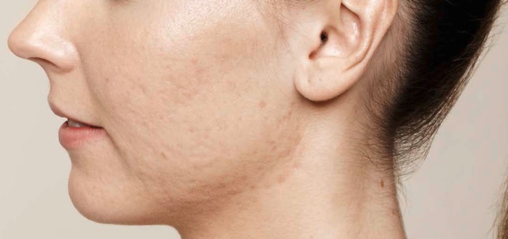 Mejilla de mujer antes de recibir un tratamiento de resurfacing facial con Láser Erbio