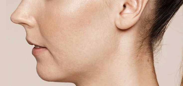 Mejilla de mujer después de recibir un tratamiento de resurfacing facial con Láser Erbio