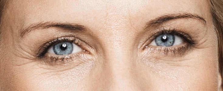 detalle de los ojos de una mujer antes de tratar las arrugas del entrecejo