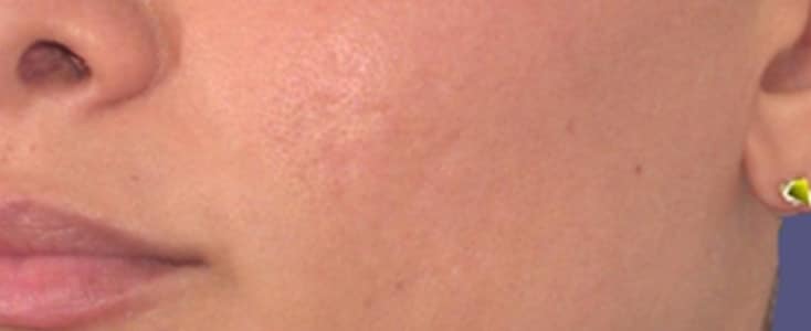 detalle de rostro después de tratamiento de cicatrices acné