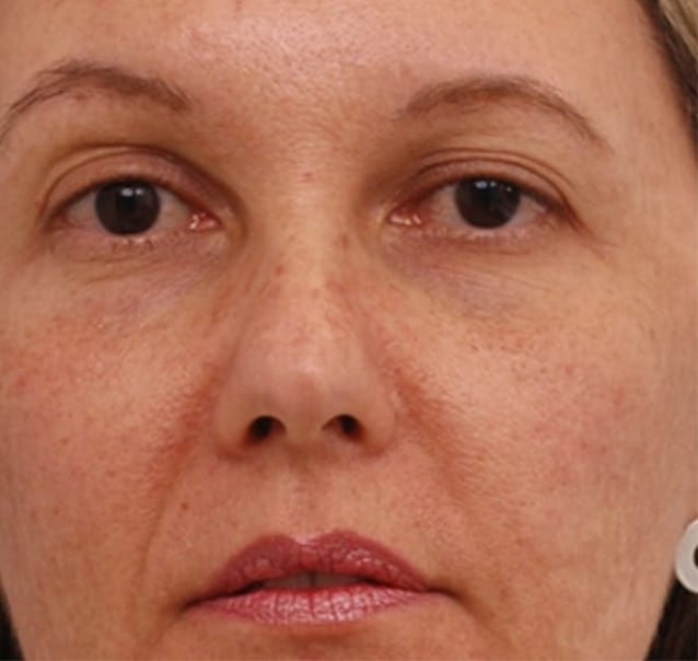 medicina estetica rejuvenecimiento facial antes