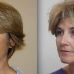 rostro de mujer madura antes y después de tratamiento con hilos tensores faciales