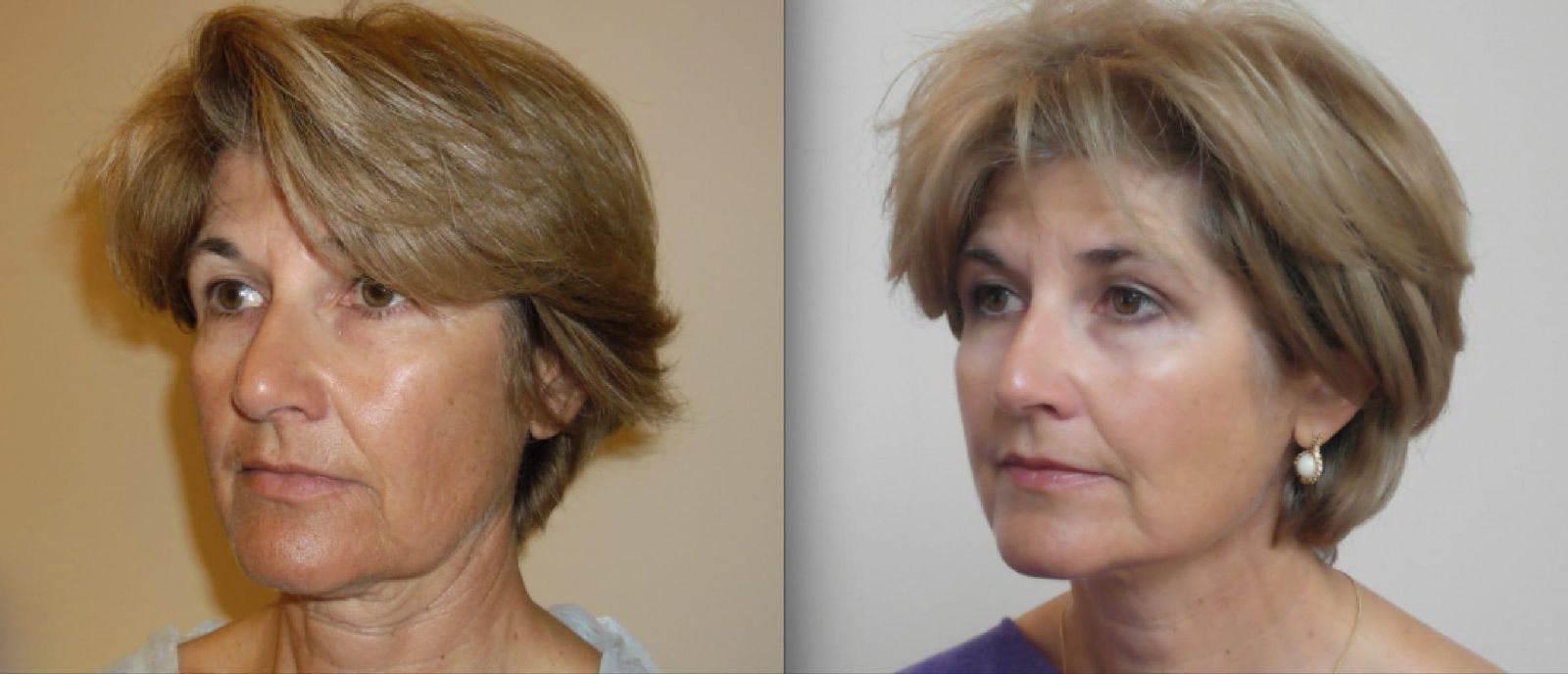 rostro de mujer madura antes y después de tratamiento con hilos tensores faciales