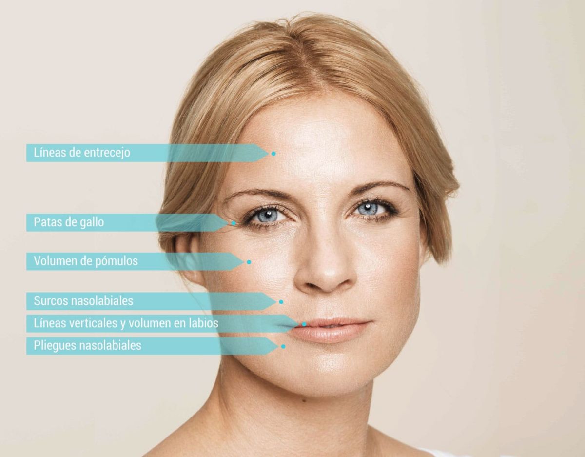 Detalle de rostro de mujer con puntos de actuación del ácido hialurónico en medicina estética