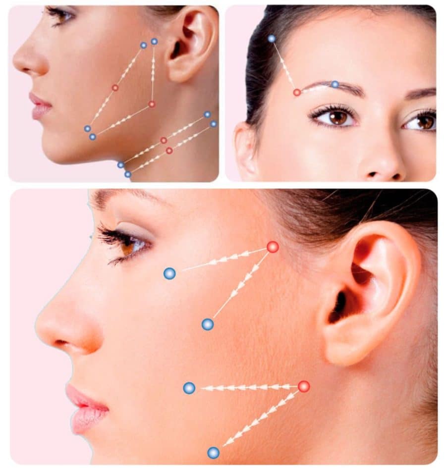 esqema sobre rostro de mujer sobre cómo funciona un tratamiento de hilos tensores silhouette soft