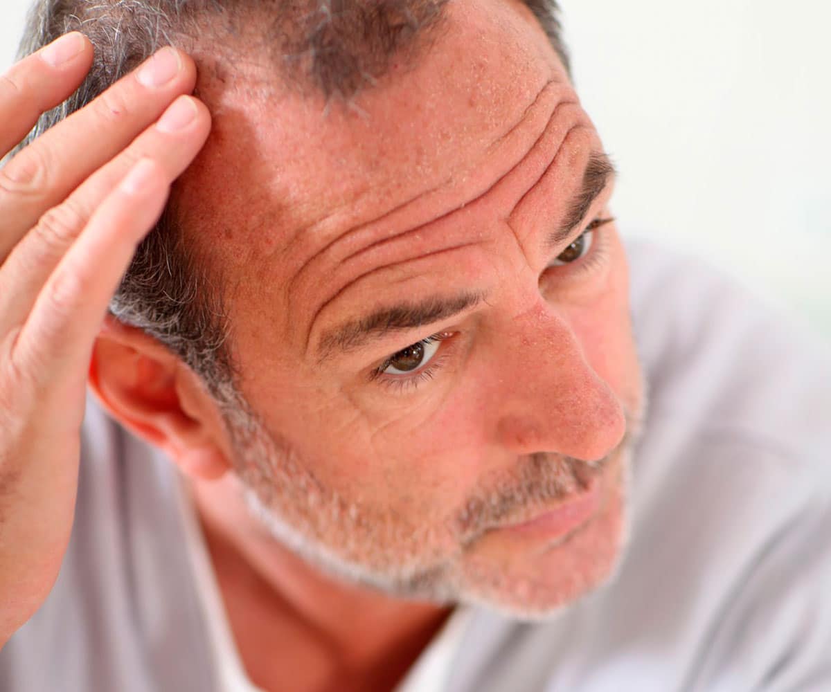 Hombre adulto señalando la parte superior de su cabeza en la zona de las entradas debido a caída prematura del cabello