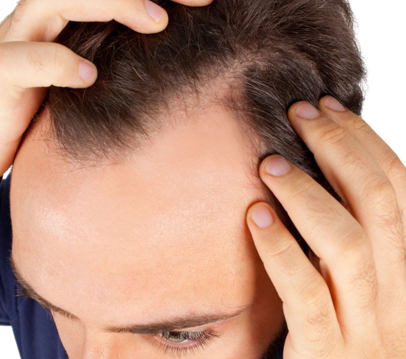 Hombre adulto separando el pelo en parte superior de su cabeza en la zona de las entradas debido a caída prematura del cabello