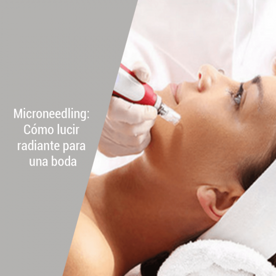 Microneedling: Como lucir radiante para una boda