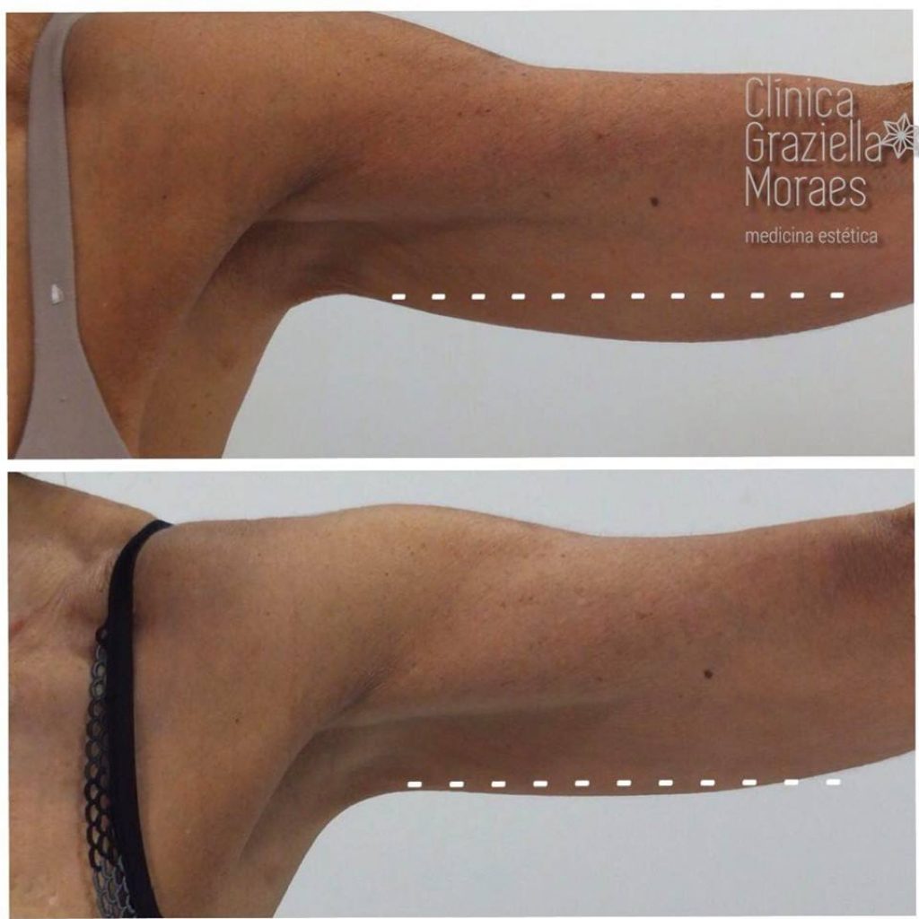 Detalle de brazos de mujer antes y después de tratamiento para reducir flacidez de brazos