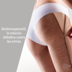 Detalle de muslos de mujer sin estrías gracias a tratamiento medicina estética