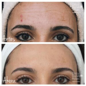 Tratamiento medicina estética con botox - Imagen antes y después de 3 semanas