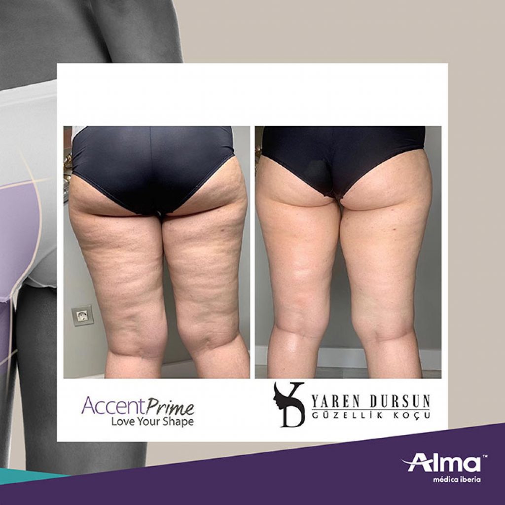 Antes y después de piernas de mujer tras Tratamiento Accent Prime Grasa