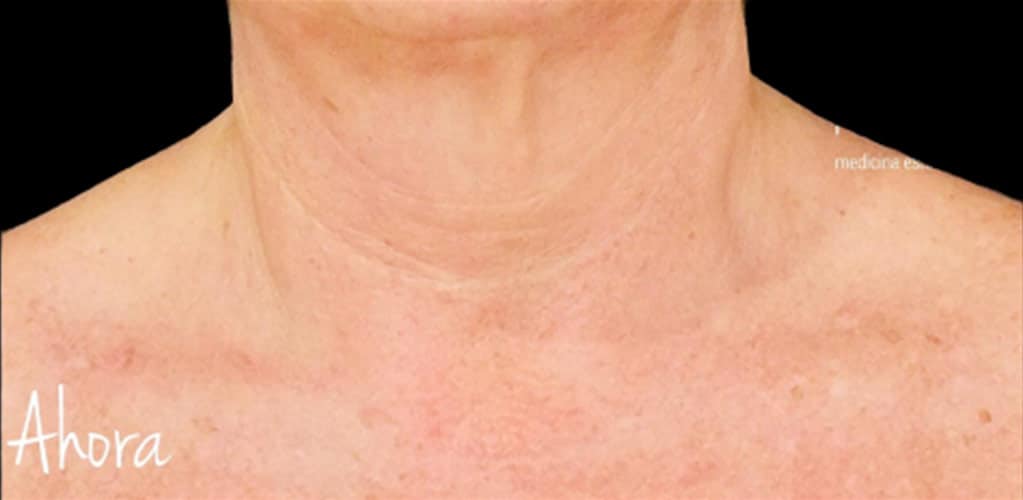 Detalle de cuello con arrugas después de tratamiento