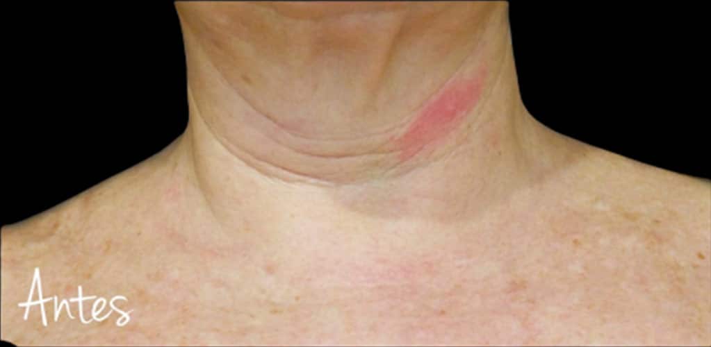 Detalle de cuello con arrugas antes de tratamiento