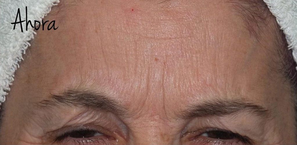 Detalle de frente de mujer después de tratamiento medicina estética con botox para reducir arrugas