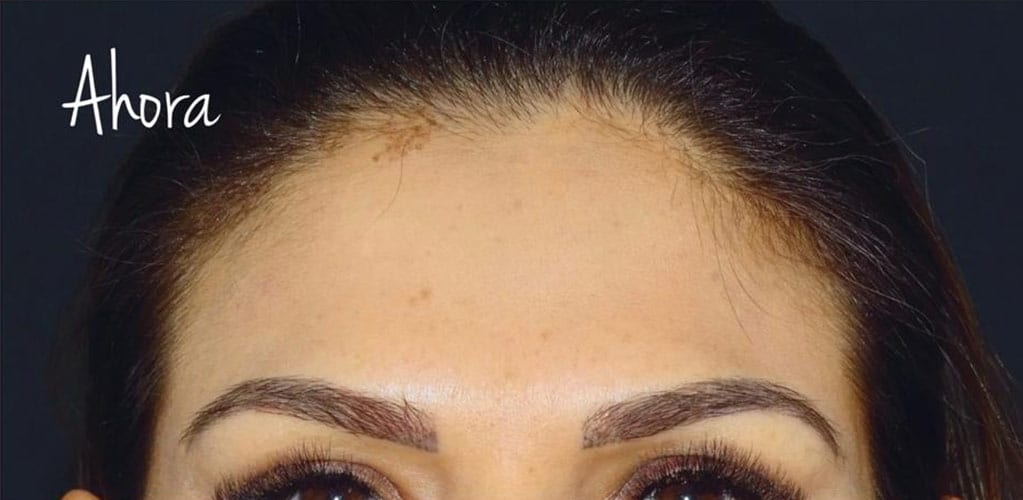Detalle de frente de mujer después de tratamiento medicina estética con botox para reducir arrugas