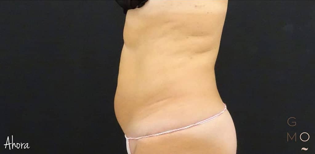 Abdomen de mujer de perfil 3 meses después de tratamiento con coolsculpting