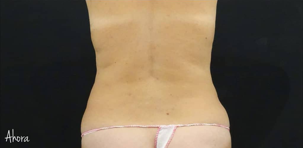 Espalda de mujer 3 meses después de tratamiento con coolsculpting