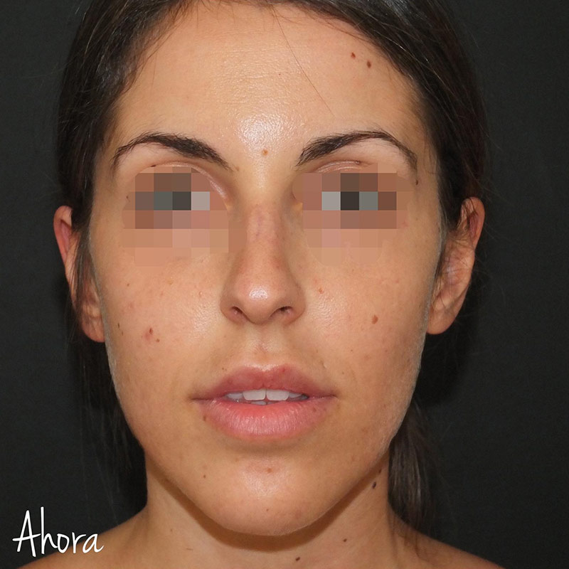 Rostro de mujer después de tratamiento full face para dar volumen y forma al tercio inferior del rostro