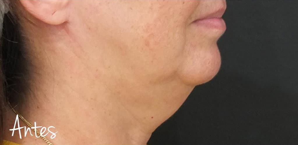 Rostro de mujer antes de tratamiento de medicina estética facial con hilos tensores para el rostro