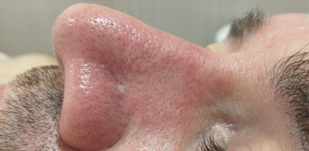 Detalle de nariz hidratada después de tratamiento hydrafacial