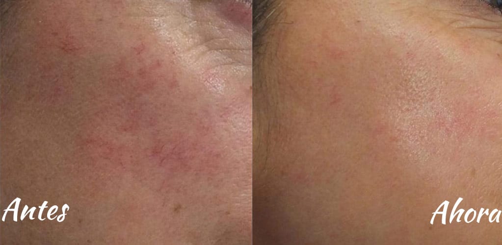 Rostro de mujer antes y después de tratamiento de reducción de mancha sen la cara con IPL