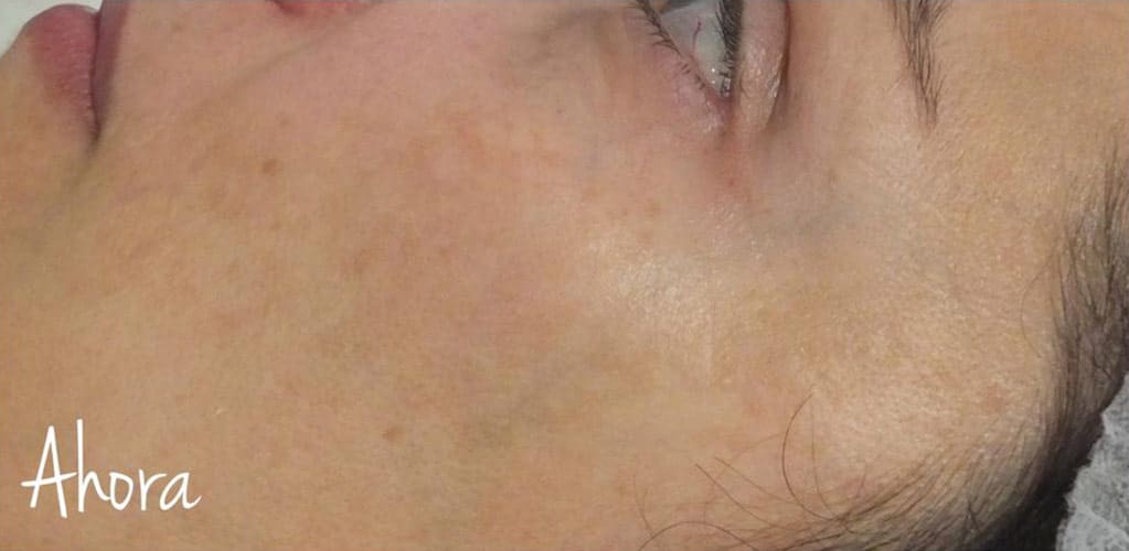 Rostro de mujer sin manchas después de tratamiento medicina estética facial con IPL