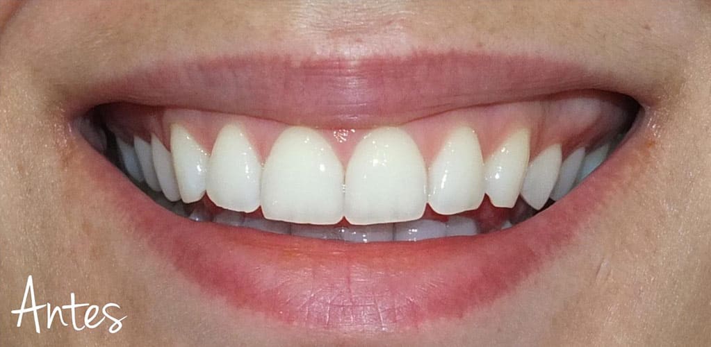 Rostro de mujer ANTES de tratamiento de labios para corregir sonrisa gingival