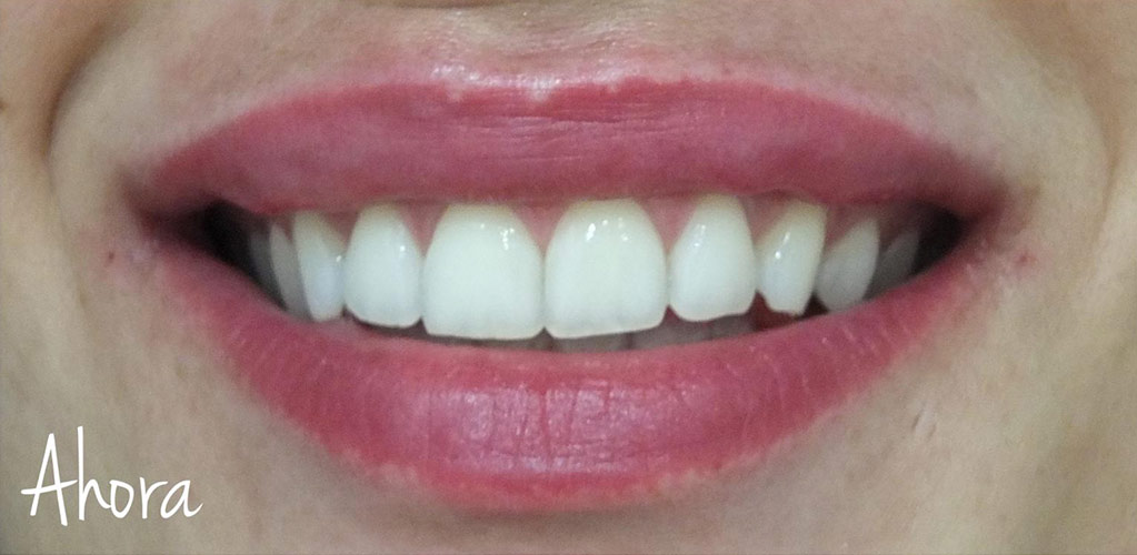 Rostro de mujer DESPUÉS de tratamiento de labios para corregir sonrisa gingival