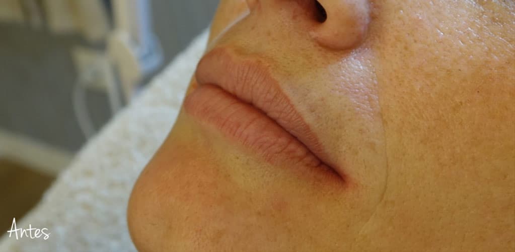 Rostro de mujer antes de tratamiento para aumentar volumen de labios