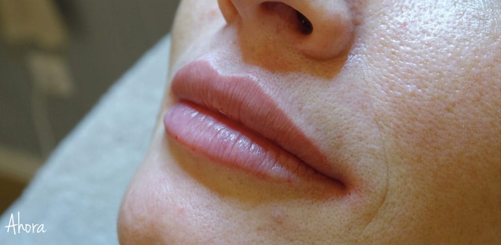Rostro de mujer después de tratamiento para aumentar volumen de labios