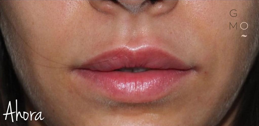 Rostro de mujer DESPUÉS de tratamiento para corregir asimetría de labios