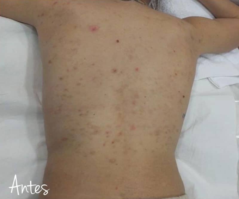 Detalle de espalda de hombre con marcas de acné