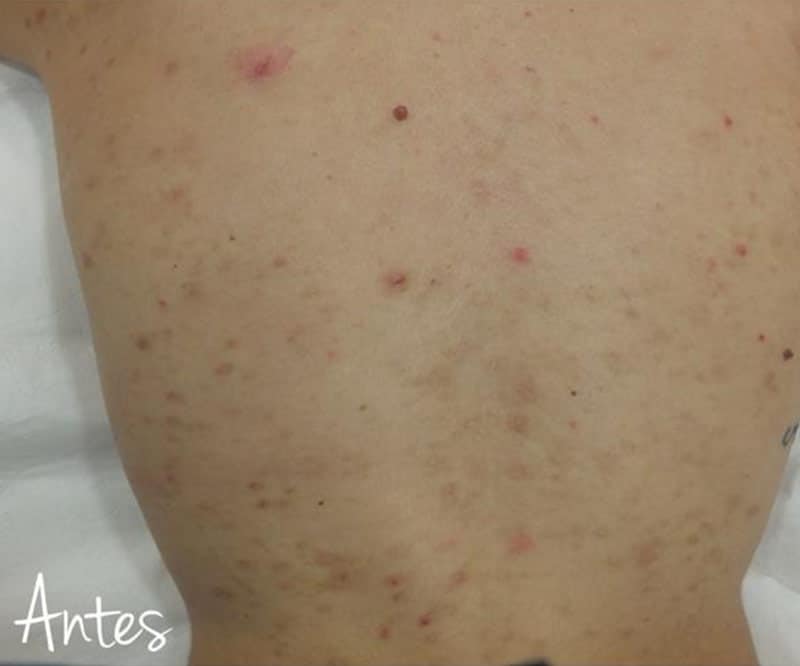 Detalle de espalda de hombre con marcas de acné