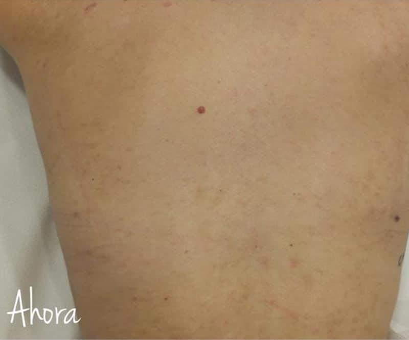 Detalle de espalda de hombre sin marcas de acné después de tratamiento medicina estética corporal