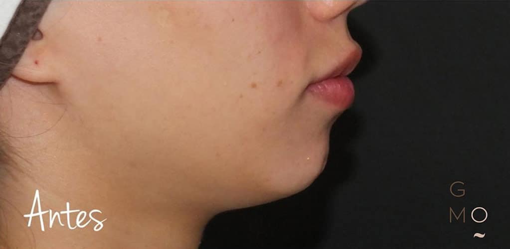 Detalle de rostro de mujer antes de tratamiento medicina estética para mejorar el óvalo facial