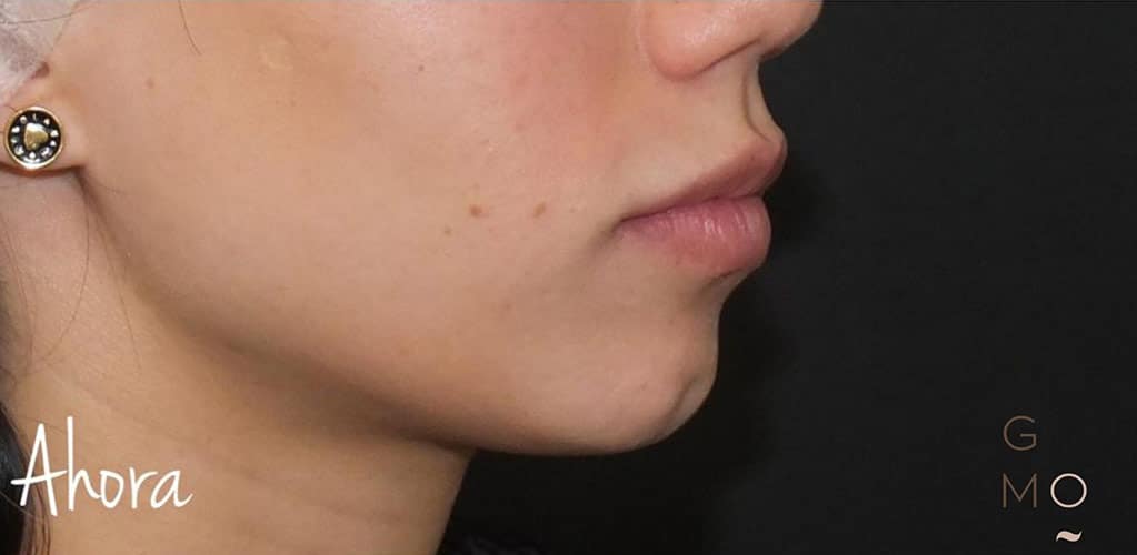 Detalle de rostro de mujer después de tratamiento medicina estética para mejorar el óvalo facial