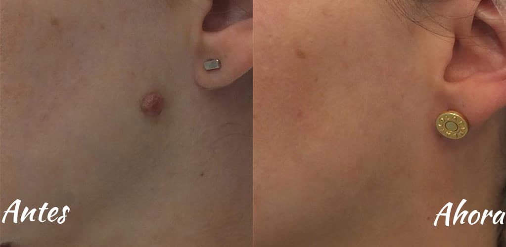 Rostro de mujer antes y después de tratamiento de eliminación de xantelasma con Plasmage