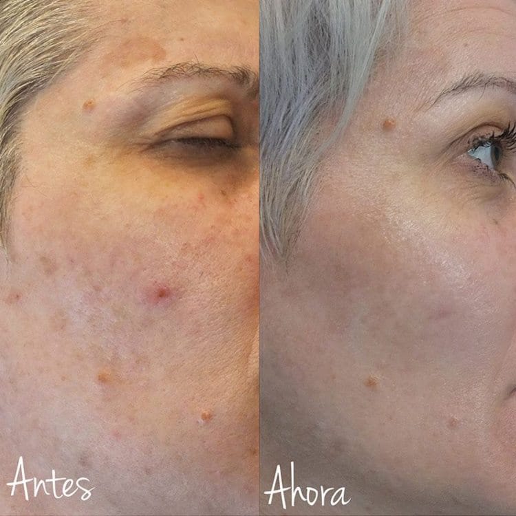 Antes y después de tratamiento de manchas en la cara con IPL