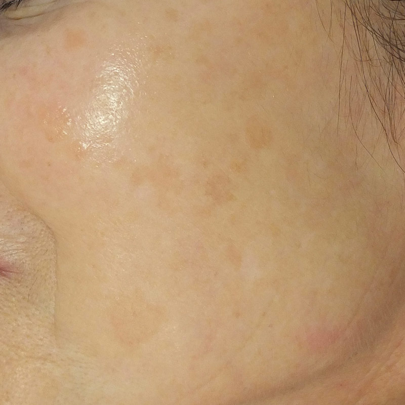 Tratamiento de manchas en la cara con tratamiento IPL - antes