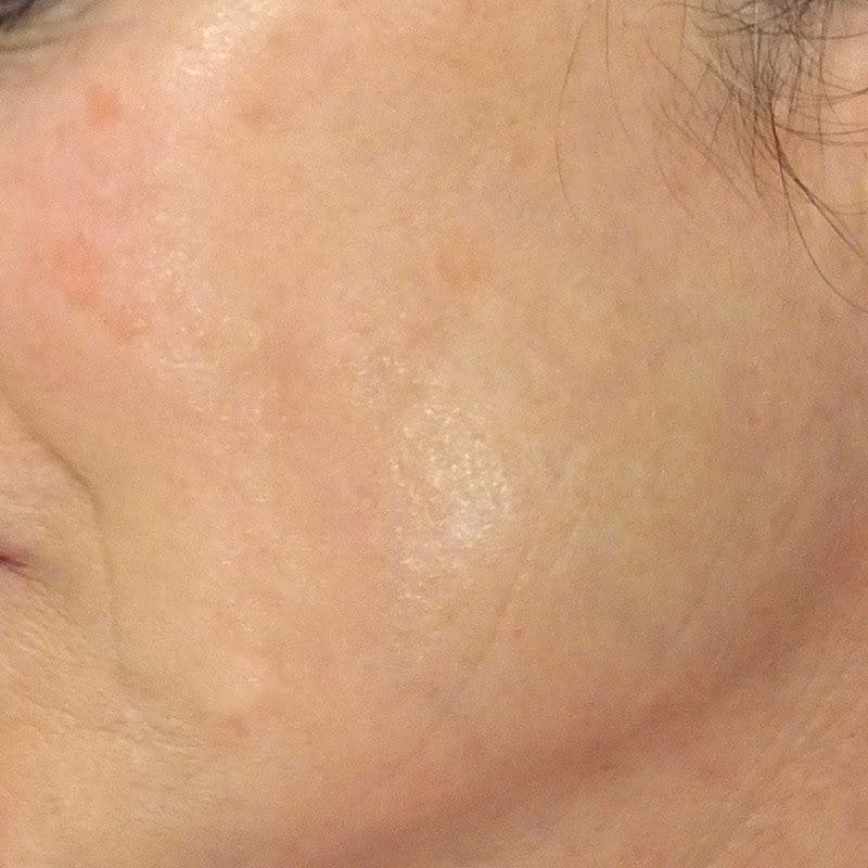 Tratamiento de manchas en la cara con tratamiento IPL - después