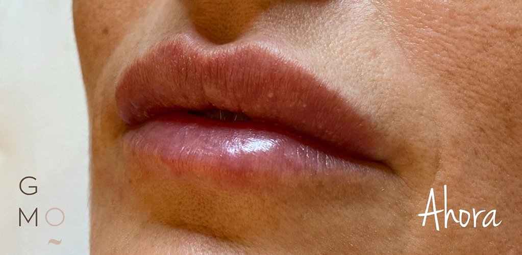 Aumento de labios con ácido hialurónico - DESPUÉS