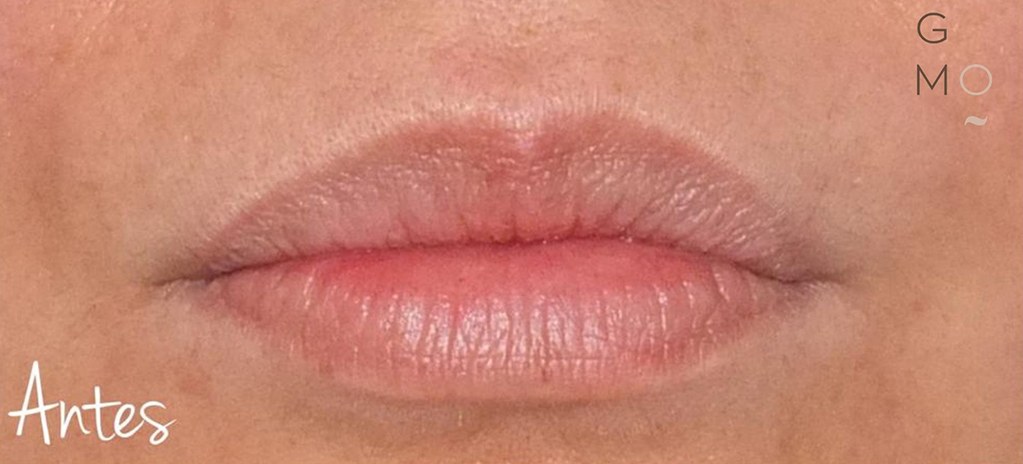 Labios de mujer ANTES de tratamiento de hidración de labios