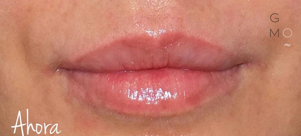 Labios de mujer DESPUÉS de tratamiento de hidración de labios