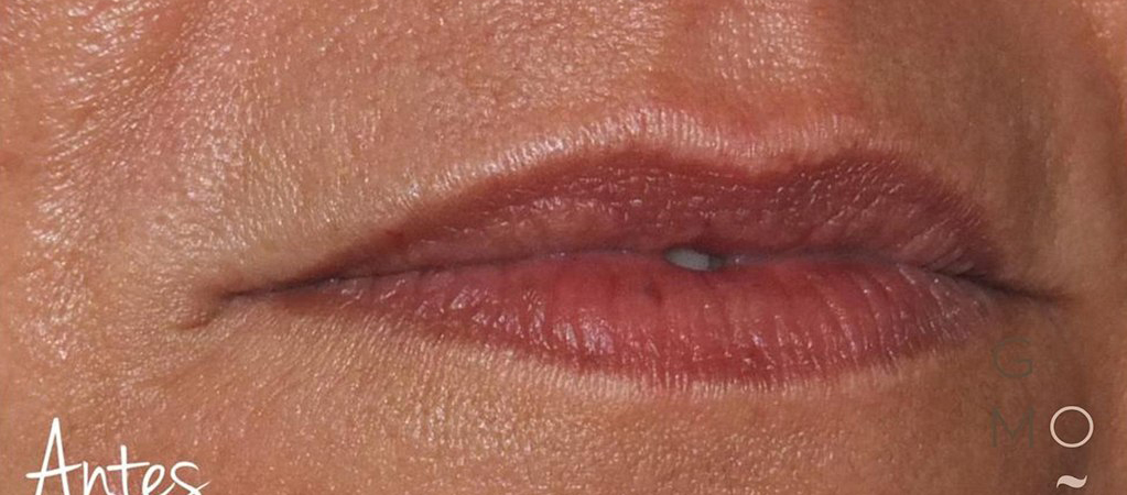 Labios de mujer ANTES de tratamiento de perfilado de labios con ácido hialurónico -