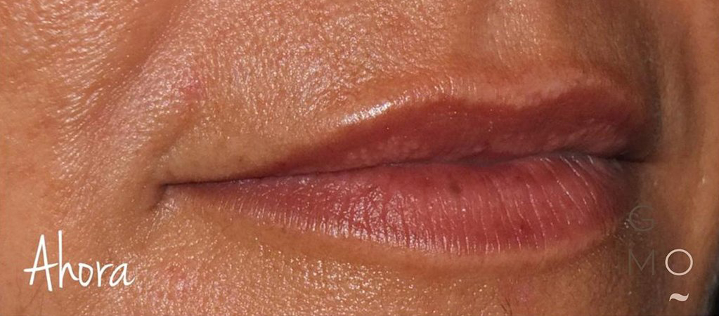 Labios de mujer DESPUÉS de tratamiento de perfilado de labios con ácido hialurónico