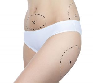 Abdomen de mujer con zonas indicadas de actuación de tratamiento de posliposucción para reducir grasa, celulitis, fliidcez