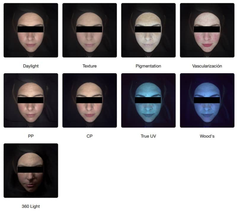 Fotografías frontales bajo diferentes luces de rostro de mujer realizadas con Observ 520X para diagnóstico facial
