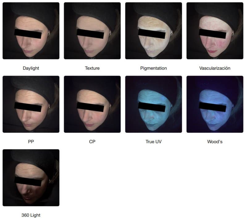 Fotografías bajo diferentes luces de parte izquierda de rostro de mujer realizadas con Observ 520X para diagnóstico facial